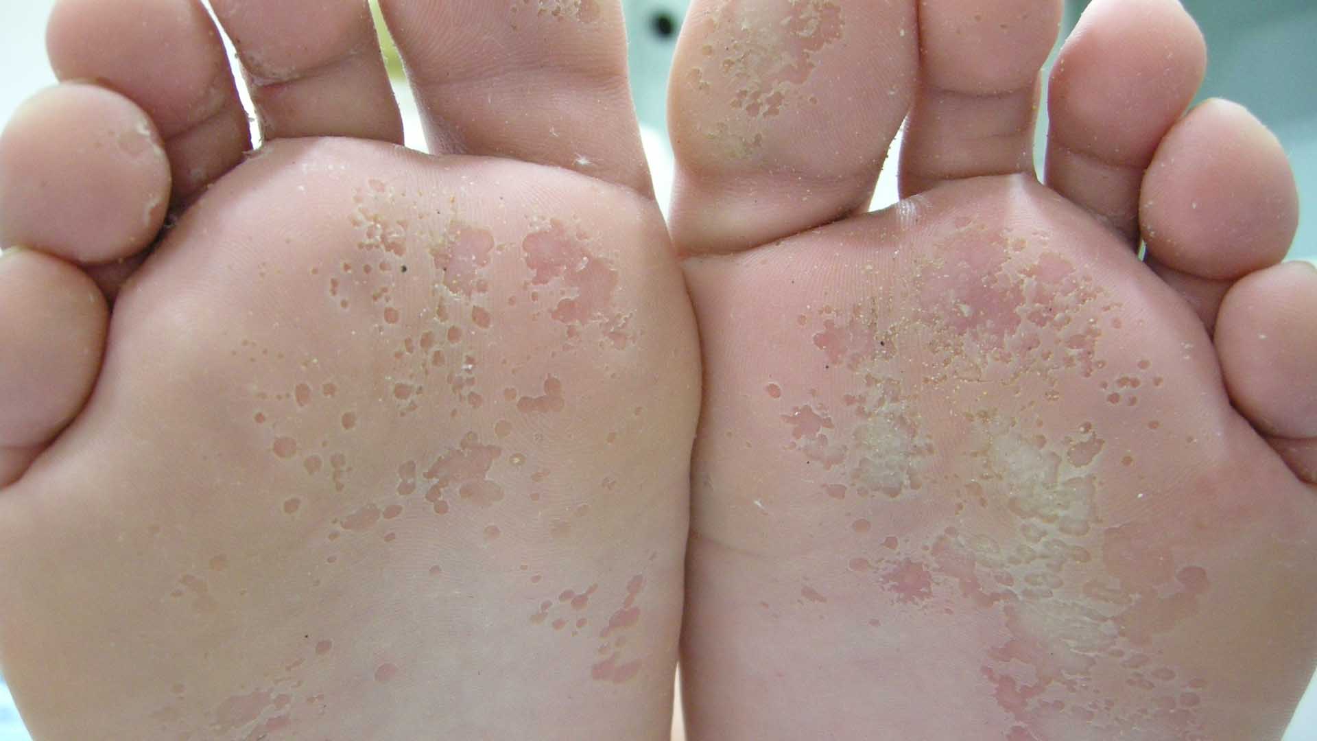 ¿Qué es el pie de atleta? síntomas y tratamiento de esta molestia