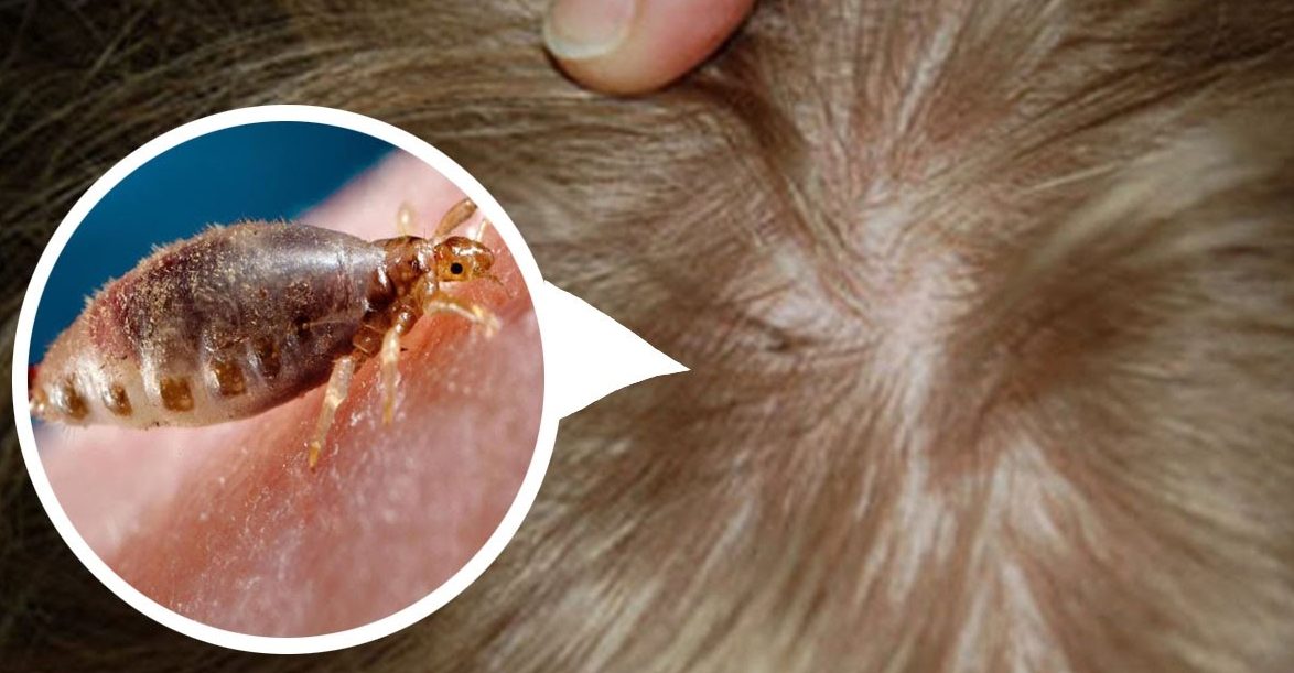 Remedios caseros para acabar con los piojos y liendres